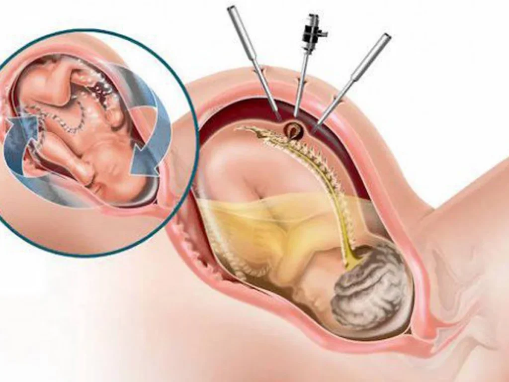 Una compleja intervención intrauterina, que se realiza sólo en dos centros del país, permite detener el proceso de daño que se produce en el mielomeningocele o espina bífida